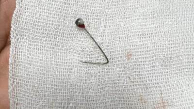 استخراج دبوس من "رئة" فتاة بلعته ببنها  