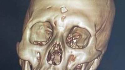 صحة الإسكندرية: انقاذ حياة شاب بعد إجراء عملية جراحية دقيقة ببرج العرب