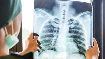 هل ظهرت سلالات جديدة من مرض الدرن في مصر ؟.. الصحة ترد 