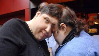 وفاة أكبر توأم ملتصق في العالم عن عمر ناهز 62 عاما