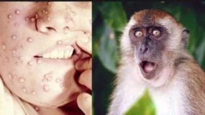 وزارة الصحة تكشف تعريف الحالات المشتبه فى إصابتها بمرض جدرى القرود