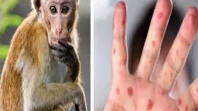 كوت ديفوار: تسجيل 28 حالة إصابة بجدري القرود بينها حالة وفاة واحدة