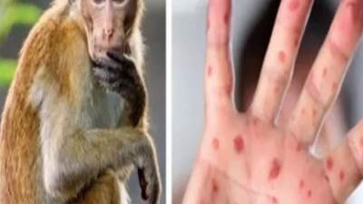 "عبدالغفار" يستعرض تقريرًا عن الحالة الوبائية لفيروس "جُدري القِردة"