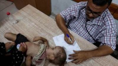 يونيسيف: أكثر من 50 ألف طفل في غزة يعانون سوء التغذية الحاد ويحتاجون إلى علاج فوري