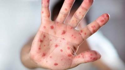 "الصحة العالمية" تنشر خطة الاستعداد والاستجابة الاستراتيجية لجدرى القرود