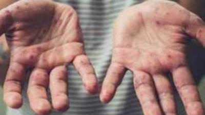 الصحة العالمية تعلن تفشي جدرى القرود في 16 دولة أفريقية