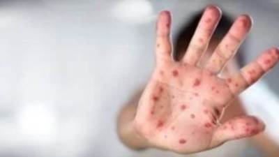 الصحة العالمية تدرج اختبارات تشخيصية إضافية لجدري القرود للاستخدام الطارئ