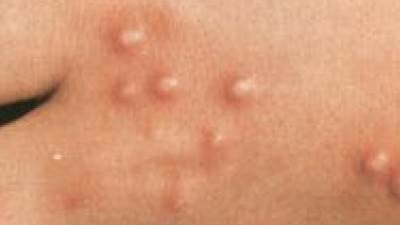 كندا تعلن أول حالة إصابة مؤكدة لسلالة جدري القرود