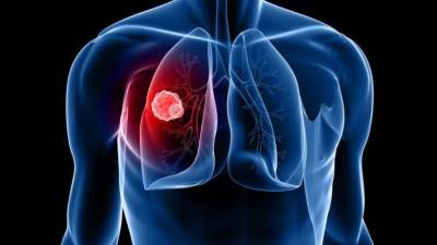 السويد تخفض وفيات سرطان الرئة بنسبة 42% خلال عقد واحد