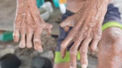 وزارة الصحة توفر علاج الجذام مجانا بعيادات الجلدية التخصصية بجميع المحافظات