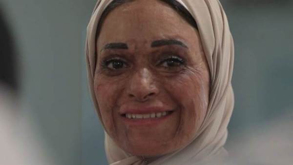 منال - إحدى الناجيات من الحروق